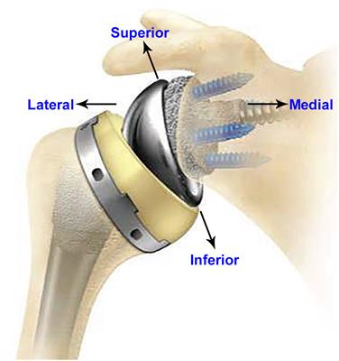 Impact of Modeling Assumptions on Stability Predictions in Reverse Total Shoulder Arthroplasty